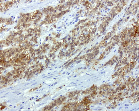 CRABP2 Antibody - Immunohistochemical staining of paraffin-embedded human endometrial carcinoma using anti-CRABB2 mouse monoclonal antibody at 1:200 dilution of 1mg/mL using Polink2 Broad HRP DAB for detection.requires HIER with citrate pH 6.0 at 110C for 3 min using pressure chamber/cooker. The composit of 3 ovarain tumors shows strong nuclear, cytoplasmic, and mebraneous staining in the tumor cells