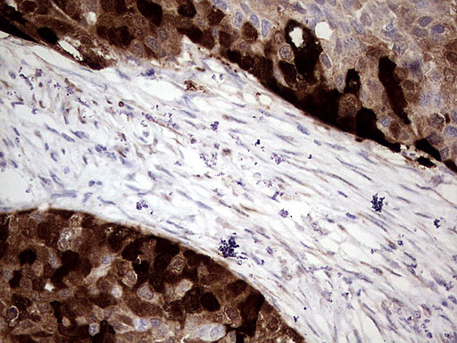 CRABP2 Antibody - Immunohistochemical staining of paraffin-embedded Carcinoma of Human kidney tissue using anti-CRABP2 mouse monoclonal antibody.  heat-induced epitope retrieval by 10mM citric buffer, pH6.0, 120C for 3min)