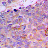 CRABP2 Antibody - Immunohistochemical analysis of CRABP2 staining in human breast cancer formalin fixed paraffin embedded tissue section. The section was pre-treated using heat mediated antigen retrieval with sodium citrate buffer (pH 6.0). The section was then incubated with the antibody at room temperature and detected using an HRP conjugated compact polymer system. DAB was used as the chromogen. The section was then counterstained with hematoxylin and mounted with DPX.