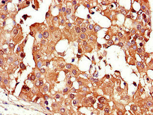 CRABP2 Antibody - Immunohistochemistry of paraffin-embedded human breast cancer using CRABP2 Antibody at dilution of 1:100