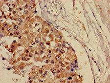 CRAT Antibody - Immunohistochemistry image of paraffin-embedded human breast cancer at a dilution of 1:100
