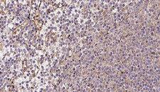 CRAT Antibody - 1:100 staining human lymph carcinoma tissue by IHC-P. The sample was formaldehyde fixed and a heat mediated antigen retrieval step in citrate buffer was performed. The sample was then blocked and incubated with the antibody for 1.5 hours at 22°C. An HRP conjugated goat anti-rabbit antibody was used as the secondary.