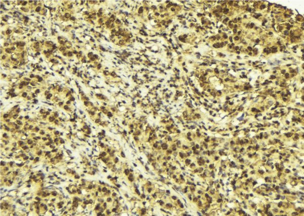 CRBN / Cereblon Antibody - 1:100 staining human breast carcinoma tissue by IHC-P. The sample was formaldehyde fixed and a heat mediated antigen retrieval step in citrate buffer was performed. The sample was then blocked and incubated with the antibody for 1.5 hours at 22°C. An HRP conjugated goat anti-rabbit antibody was used as the secondary.