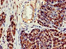 CRCP / CGRP Receptor Component Antibody - Immunohistochemistry image of paraffin-embedded human ovarian cancer at a dilution of 1:100