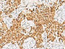 CRCP / CGRP Receptor Component Antibody - Immunohistochemistry of paraffin-embedded Human ovarian cancer tissue  using CRCP Polyclonal Antibody at dilution of 1:65(×200)