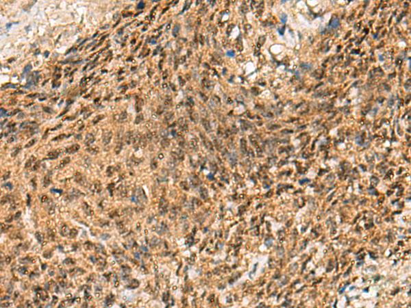 CRCP / CGRP Receptor Component Antibody - Immunohistochemistry of paraffin-embedded Human cervical cancer tissue  using CRCP Polyclonal Antibody at dilution of 1:65(×200)