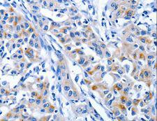 CRD-BP / ZBP1 / IGF2BP1 Antibody - Immunohistochemistry of paraffin-embedded Human lung cancer using IGF2BP1 Polyclonal Antibody at dilution of 1:25.