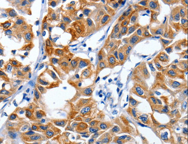 CRD-BP / ZBP1 / IGF2BP1 Antibody - Immunohistochemistry of paraffin-embedded Human lung cancer using IGF2BP1 Polyclonal Antibody at dilution of 1:40.