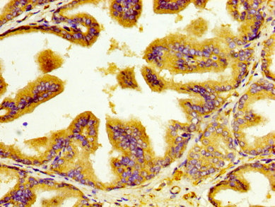 CRD-BP / ZBP1 / IGF2BP1 Antibody - Immunohistochemistry image at a dilution of 1:400 and staining in paraffin-embedded human prostate tissue performed on a Leica BondTM system. After dewaxing and hydration, antigen retrieval was mediated by high pressure in a citrate buffer (pH 6.0) . Section was blocked with 10% normal goat serum 30min at RT. Then primary antibody (1% BSA) was incubated at 4 °C overnight. The primary is detected by a biotinylated secondary antibody and visualized using an HRP conjugated SP system.