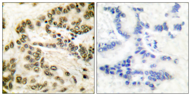 CREB1 / CREB Antibody - Immunohistochemistry analysis of paraffin-embedded human lung carcinoma tissue, using CREB Antibody. The picture on the right is blocked with the synthesized peptide.