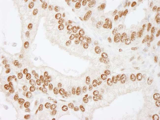 CREB1 / CREB Antibody - Detection of Human CREB by Immunohistochemistry. Sample: FFPE section of human prostate carcinoma. Antibody: Affinity purified rabbit anti-CREB used at a dilution of 1:250.