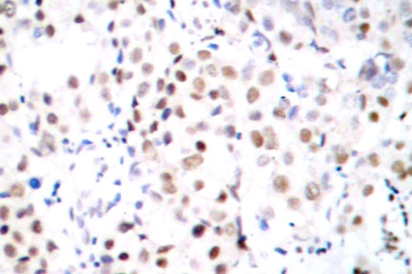 CREB1 / CREB Antibody - IHC of CREB (I127) pAb in paraffin-embedded human breast carcinoma tissue.