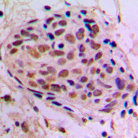 CREB1 / CREB Antibody - Immunohistochemical analysis of CREB staining in human breast cancer formalin fixed paraffin embedded tissue section. The section was pre-treated using heat mediated antigen retrieval with sodium citrate buffer (pH 6.0). The section was then incubated with the antibody at room temperature and detected using an HRP conjugated compact polymer system. DAB was used as the chromogen. The section was then counterstained with hematoxylin and mounted with DPX.