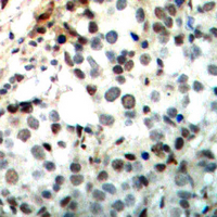 CREB1 / CREB Antibody - Immunohistochemical analysis of CREB staining in human breast cancer formalin fixed paraffin embedded tissue section. The section was pre-treated using heat mediated antigen retrieval with sodium citrate buffer (pH 6.0). The section was then incubated with the antibody at room temperature and detected using an HRP conjugated compact polymer system. DAB was used as the chromogen. The section was then counterstained with hematoxylin and mounted with DPX.