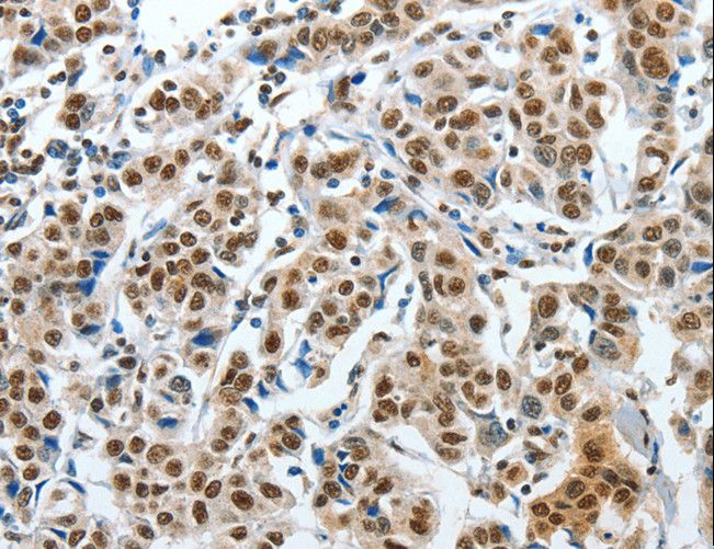 CREB1 / CREB Antibody - Immunohistochemistry of paraffin-embedded Human cervical cancer using CREB1 Polyclonal Antibody at dilution of 1:30.
