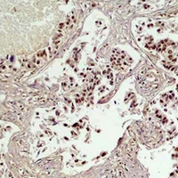 CREB1 / CREB Antibody - Immunohistochemical analysis of CREB staining in human lung cancer formalin fixed paraffin embedded tissue section. The section was pre-treated using heat mediated antigen retrieval with sodium citrate buffer (pH 6.0). The section was then incubated with the antibody at room temperature and detected using an HRP conjugated compact polymer system. DAB was used as the chromogen. The section was then counterstained with hematoxylin and mounted with DPX.