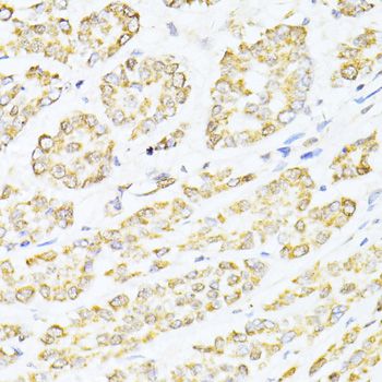 CREB1 / CREB Antibody - Immunohistochemistry of paraffin-embedded human colon carcinoma using CREB1 antibody at dilution of 1:100 (40x lens).