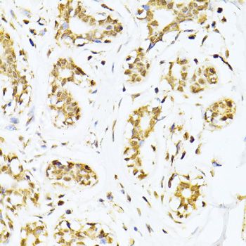 CREB1 / CREB Antibody - Immunohistochemistry of paraffin-embedded human breast cancer using CREB1 antibody at dilution of 1:100 (40x lens).