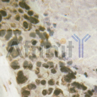 CREB1 / CREB Antibody - 1/100 staining human breast carcinoma tissue by IHC-P. The sample was formaldehyde fixed and a heat mediated antigen retrieval step in citrate buffer was performed. The sample was then blocked and incubated with the antibody for 1.5 hours at 22°C. An HRP conjugated goat anti-rabbit antibody was used as the secondary antibody.
