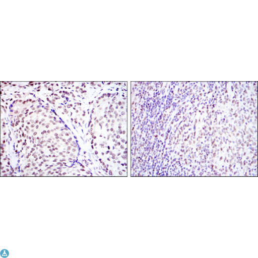 CREB1 / CREB Antibody - Immunohistochemistry (IHC) analysis of paraffin-embedded prostate cancer tissues (left) and submaxillary tumor tissues (right) with DAB staining using CREB-1 Monoclonal Antibody.