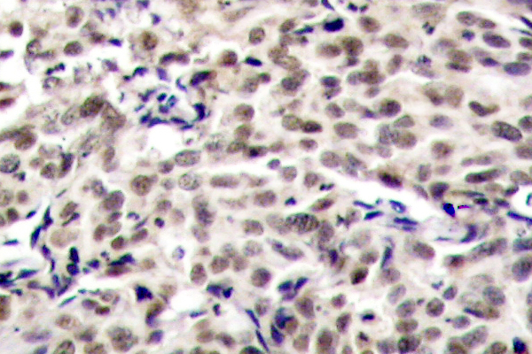 CREB1 / CREB Antibody - IHC of CREB (K123) pAb in paraffin-embedded human breast carcinoma tissue.