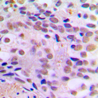 CREB1 / CREB Antibody - Immunohistochemical analysis of CREB (pS121) staining in human breast cancer formalin fixed paraffin embedded tissue section. The section was pre-treated using heat mediated antigen retrieval with sodium citrate buffer (pH 6.0). The section was then incubated with the antibody at room temperature and detected using an HRP conjugated compact polymer system. DAB was used as the chromogen. The section was then counterstained with hematoxylin and mounted with DPX.