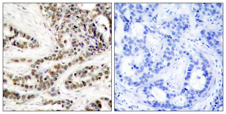 CREB1 / CREB Antibody - Immunohistochemistry analysis of paraffin-embedded human breast carcinoma, using CREB (Phospho-Ser129) Antibody. The picture on the right is blocked with the phospho peptide.