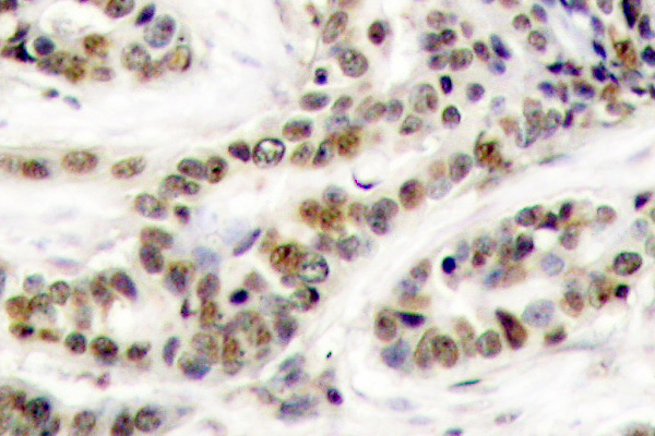 CREB1 / CREB Antibody - IHC of p-CREB-1 (S129) pAb in paraffin-embedded human breast carcinoma tissue.