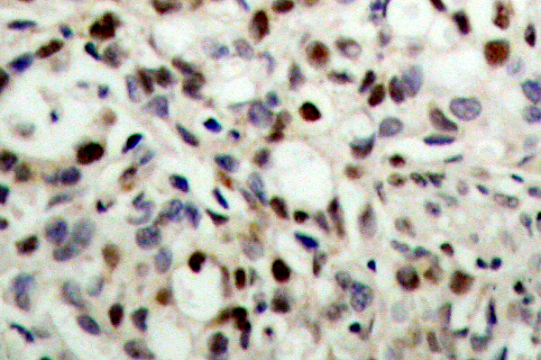 CREB1 / CREB Antibody - IHC of p-CREB (S133) pAb in paraffin-embedded human breast carcinoma tissue.