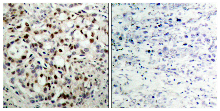 CREB1 / CREB Antibody - Immunohistochemistry analysis of paraffin-embedded human breast carcinoma, using CREB (Phospho-Ser133) Antibody. The picture on the right is blocked with the phospho peptide.