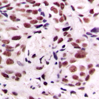 CREB1 / CREB Antibody - Immunohistochemical analysis of CREB (pS133) staining in human breast cancer formalin fixed paraffin embedded tissue section. The section was pre-treated using heat mediated antigen retrieval with sodium citrate buffer (pH 6.0). The section was then incubated with the antibody at room temperature and detected using an HRP conjugated compact polymer system. DAB was used as the chromogen. The section was then counterstained with hematoxylin and mounted with DPX.