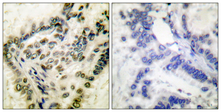 CREB1 / CREB Antibody - Immunohistochemistry analysis of paraffin-embedded human lung carcinoma, using CREB (Phospho-Ser142) Antibody. The picture on the right is blocked with the phospho peptide.