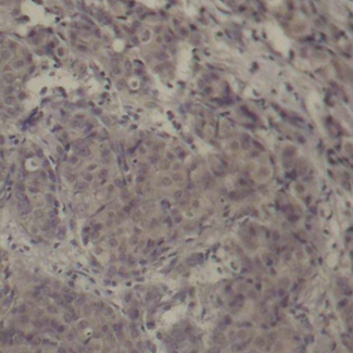 CREB1 / CREB Antibody - Immunohistochemical analysis of paraffin-embedded human breast carcinoma tissue.