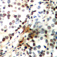 CREB1 / CREB Antibody - Immunohistochemical analysis of CREB (pS142) staining in human breast cancer formalin fixed paraffin embedded tissue section. The section was pre-treated using heat mediated antigen retrieval with sodium citrate buffer (pH 6.0). The section was then incubated with the antibody at room temperature and detected using an HRP conjugated compact polymer system. DAB was used as the chromogen. The section was then counterstained with hematoxylin and mounted with DPX.