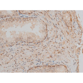 CREB1 / CREB Antibody - 1:200 staining human prostate tissue by IHC-P. The tissue was formaldehyde fixed and a heat mediated antigen retrieval step in citrate buffer was performed. The tissue was then blocked and incubated with the antibody for 1.5 hours at 22°C. An HRP conjugated goat anti-rabbit antibody was used as the secondary.