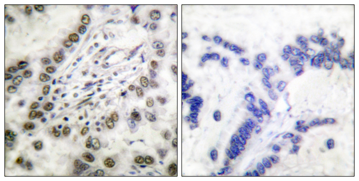 CREBBP / CREB Binding Protein Antibody - Immunohistochemistry analysis of paraffin-embedded human lung carcinoma tissue, using CBP Antibody. The picture on the right is blocked with the synthesized peptide.