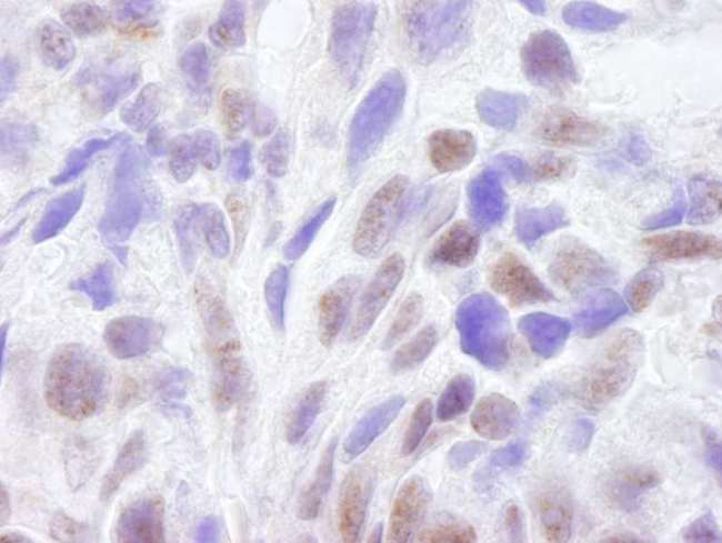 CREBBP / CREB Binding Protein Antibody - Detection of Human CBP by Immunohistochemistry. Sample: FFPE section of human breast adenocarcinoma (lower image). Antibody: Affinity purified rabbit anti-CBP used at a dilution of 1:250. Detection: DAB.
