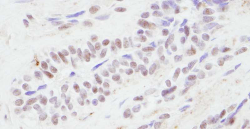 CREBBP / CREB Binding Protein Antibody - Detection of Human CBP by Immunohistochemistry. Sample: FFPE section of human prostate carcinoma. Antibody: Affinity purified rabbit anti-CBP used at a dilution of 1:500 (2 ug/ml).