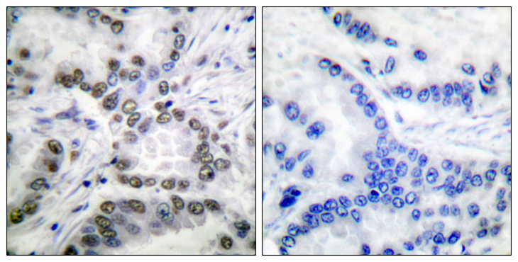 CREBBP / CREB Binding Protein Antibody - Immunohistochemistry analysis of paraffin-embedded human lung carcinoma tissue, using CBP (Acetyl-Lys1535) Antibody. The picture on the right is blocked with the synthesized peptide.