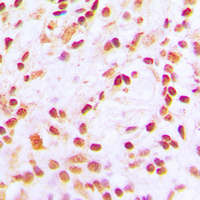 CREBBP / CREB Binding Protein Antibody - Immunohistochemical analysis of CBP (AcK1535) staining in human lung cancer formalin fixed paraffin embedded tissue section. The section was pre-treated using heat mediated antigen retrieval with sodium citrate buffer (pH 6.0). The section was then incubated with the antibody at room temperature and detected using an HRP conjugated compact polymer system. DAB was used as the chromogen. The section was then counterstained with hematoxylin and mounted with DPX.