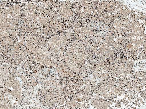 CREBBP / CREB Binding Protein Antibody - Immunohistochemistry analysis using Rabbit Anti-CBP Polyclonal Antibody. Tissue: Breast Cancer. Species: Human. Fixation: Formalin Fixed Paraffin-Embedded. Primary Antibody: Rabbit Anti-CBP Polyclonal Antibody  at 1:50 for 30 min at RT. Counterstain: Hematoxylin. Magnification: 10X. HRP-DAB Detection.