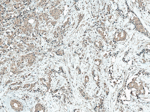 CREBBP / CREB Binding Protein Antibody - Immunohistochemistry analysis using Rabbit Anti-CBP Polyclonal Antibody. Tissue: Breast Cancer. Species: Human. Fixation: Formalin Fixed Paraffin-Embedded. Primary Antibody: Rabbit Anti-CBP Polyclonal Antibody  at 1:50 for 30 min at RT. Counterstain: Hematoxylin. Magnification: 10X. HRP-DAB Detection.