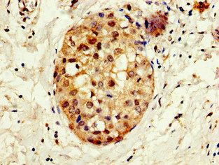 CREBBP / CREB Binding Protein Antibody - Immunohistochemistry image of paraffin-embedded human breast cancer at a dilution of 1:100