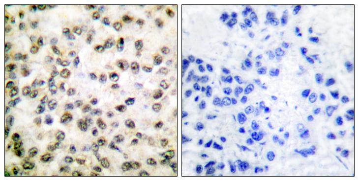 CREBBP / CREB Binding Protein Antibody - Peptide - + Immunohistochemical analysis of paraffin-embedded human breast carcinoma tissue using CREB-BP antibody.
