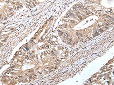 CREBL1 / ATF6B Antibody - Immunohistochemistry of paraffin-embedded Human colorectal cancer tissue  using ATF6B Polyclonal Antibody at dilution of 1:30(×200)