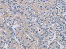 CREBZF / Zhangfei Antibody - Immunohistochemistry of paraffin-embedded Human liver cancer tissue  using CREBZF Polyclonal Antibody at dilution of 1:50(×200)