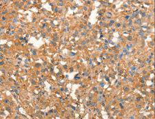 CRELD1 Antibody - Immunohistochemistry of paraffin-embedded Human thyroid cancer using CRELD1 Polyclonal Antibody at dilution of 1:40.