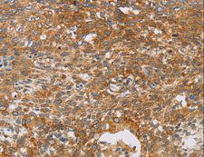 CRELD2 Antibody - Immunohistochemistry of paraffin-embedded Human cervical cancer using CRELD2 Polyclonal Antibody at dilution of 1:40.