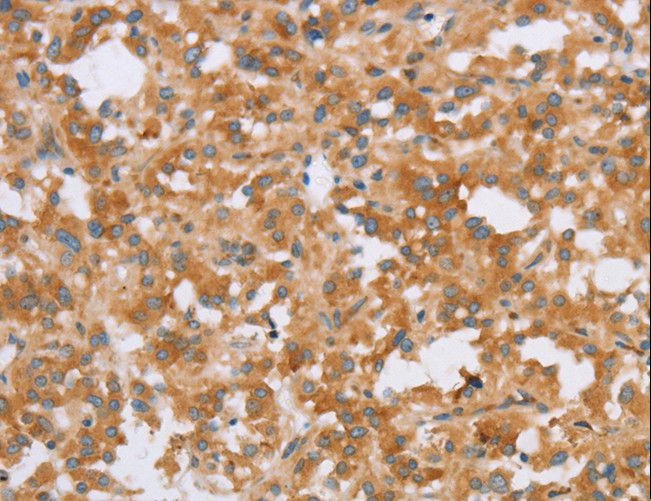 CRELD2 Antibody - Immunohistochemistry of paraffin-embedded Human thyroid cancer using CRELD2 Polyclonal Antibody at dilution of 1:40.