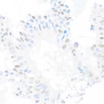 CREM / ICER Antibody - Immunohistochemistry of paraffin-embedded Human mammary cancer using CREM Polyclonal Antibody at dilution of 1:100 (40x lens).